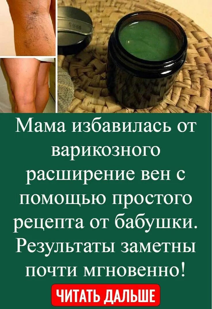 Целебная чудо-мазь. Фитотерапия при варикозе ног. Народное средство от варикоза на ногах. Народные средства от варикоза вен. Варикозное расширение вен.