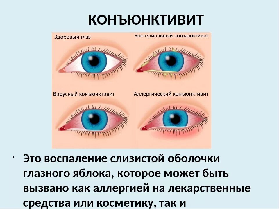 Как называется болезнь зрения. Болезнь глаз конъюнктивит. Предупреждение заболеваний глаз. Профилактика болезней глаз.