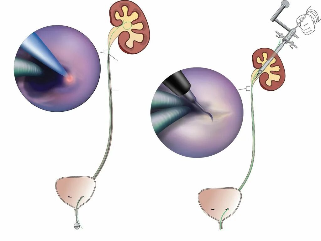 Удаление стенда из мочеточника. Катетеризация мочеточника. Цистоскопия мочеточника. Катетеризация мочеточника, почечной лоханки.