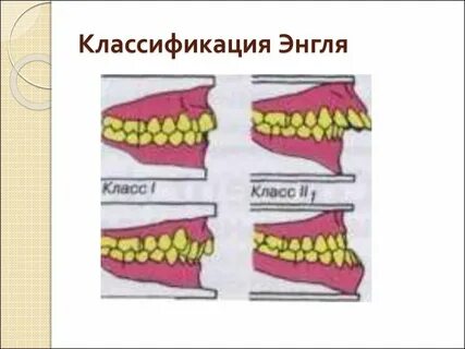 Ортодонтия классификация