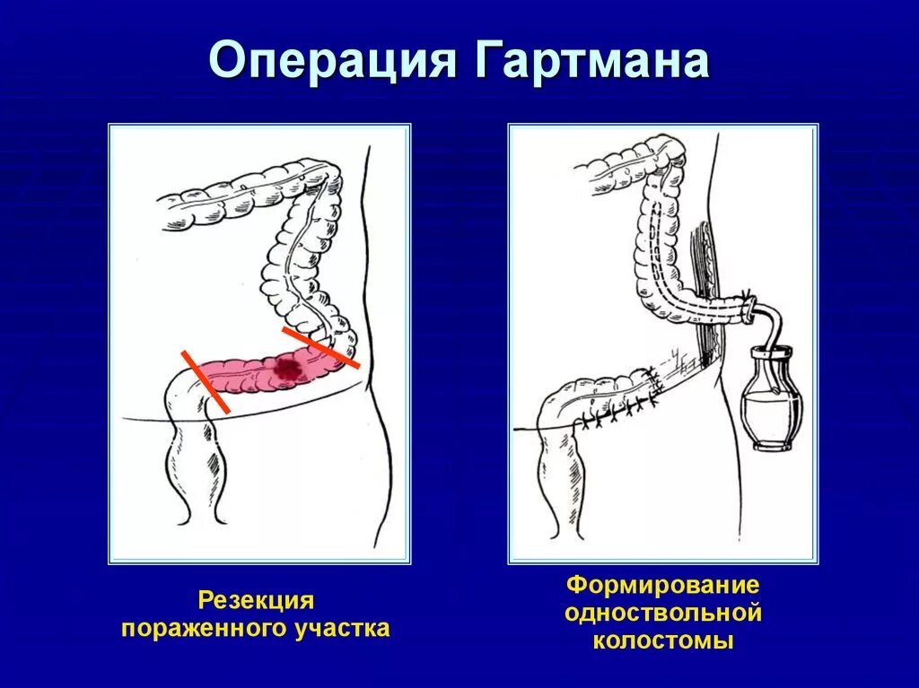 Резекция прямой кишки по Гартману. Операция Гартмана передняя резекция прямой кишки. Операция Гартмана на толстой кишке. Резекция толстой кишки по Гартману.