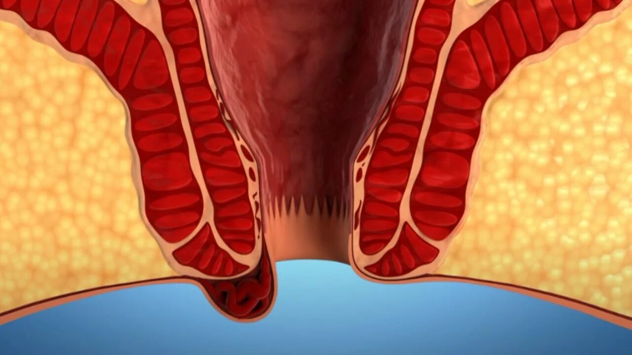 Ощущение в прямой кишке. Внутренние геморройные узлы. Выпадение геморроидальных шишек.