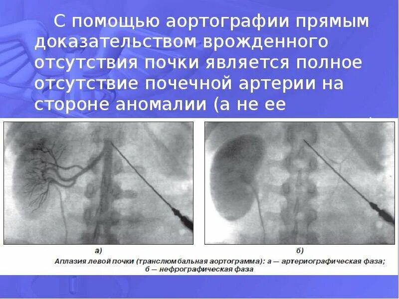 Агенезия и аплазия почки. Агенезия почки рентген. Аплазия. Макропрепарат аплазия почка. Аномалия развития аплазия  левой  почки.