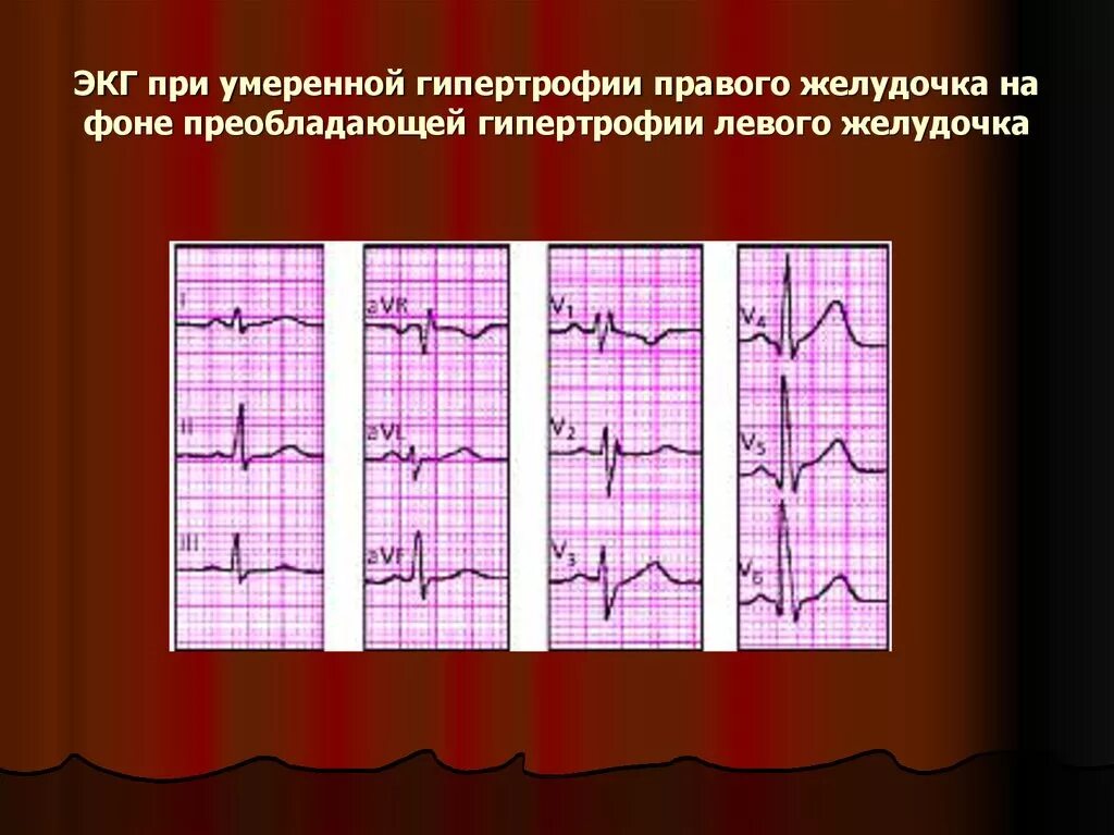 Гипертрофия левого предсердия и правого желудочка на ЭКГ. Гипертрофия левого желудочка на ЭКГ. ЭКГ при гипертрофии лж. Гипертрофия желудочков на ЭКГ. Экг преобладание левого желудочка