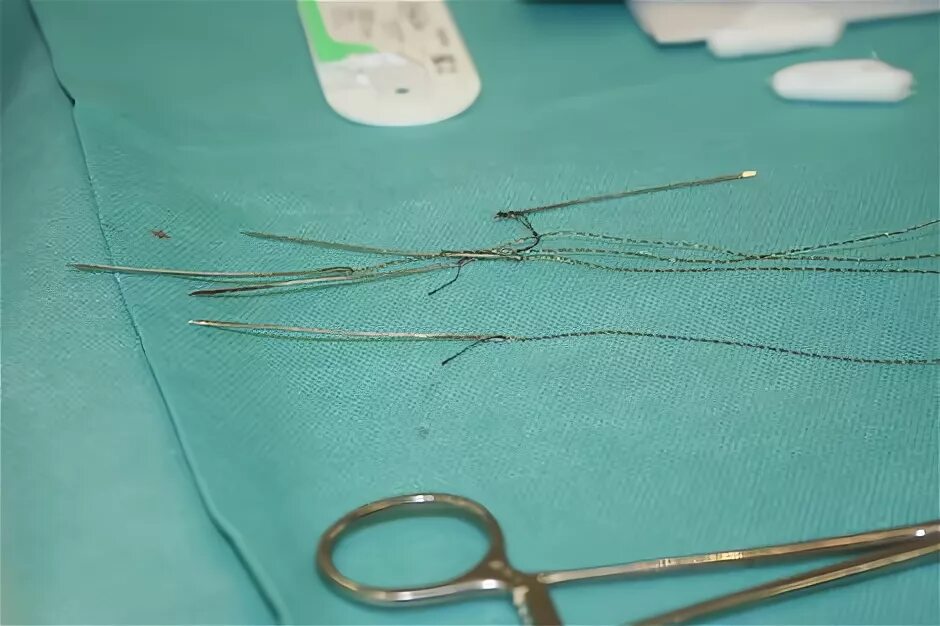 Сколько рассасываются нитки после операции