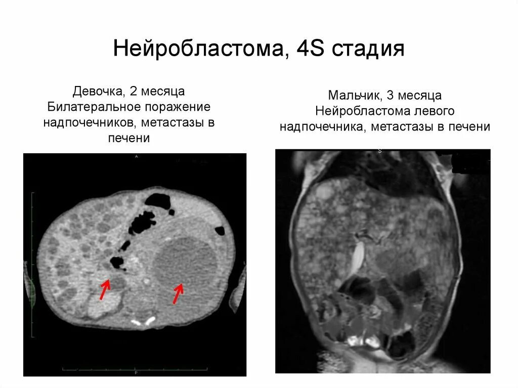 Метастазы у ребенка