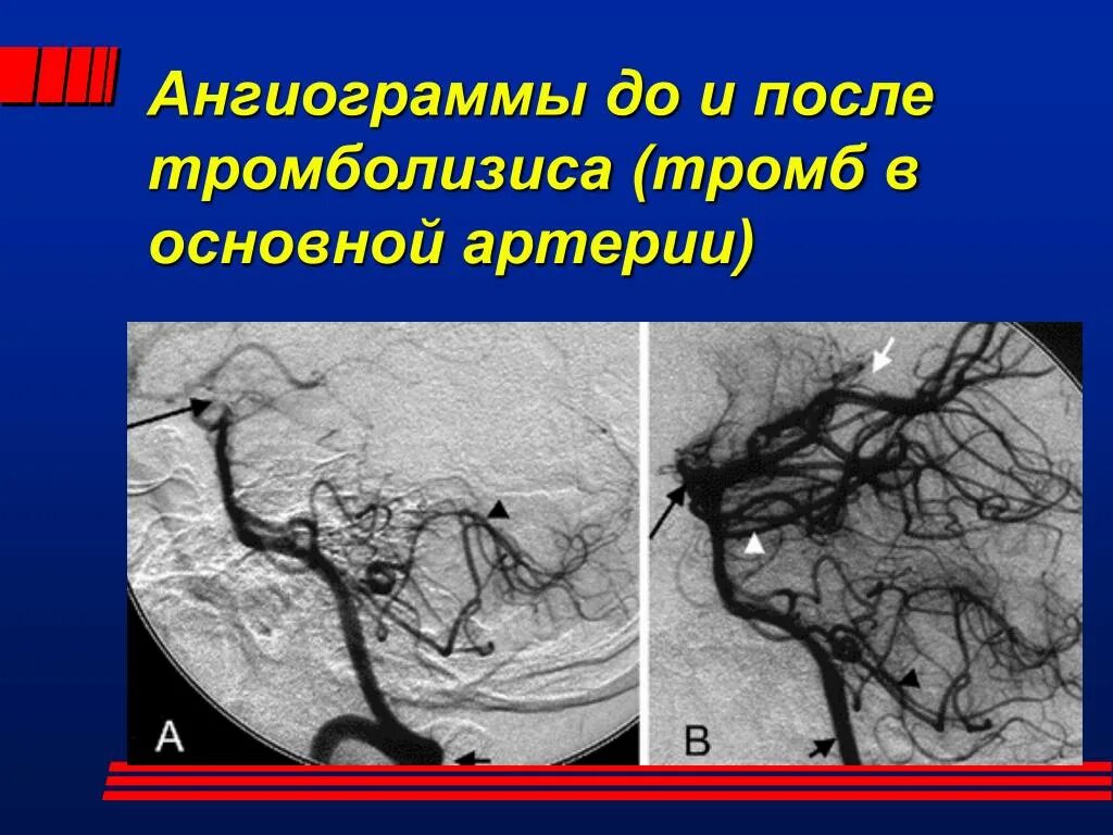 Ангиограммы. Тромб основной артерии. Тромб основной артерии головного мозга. Основной тромб