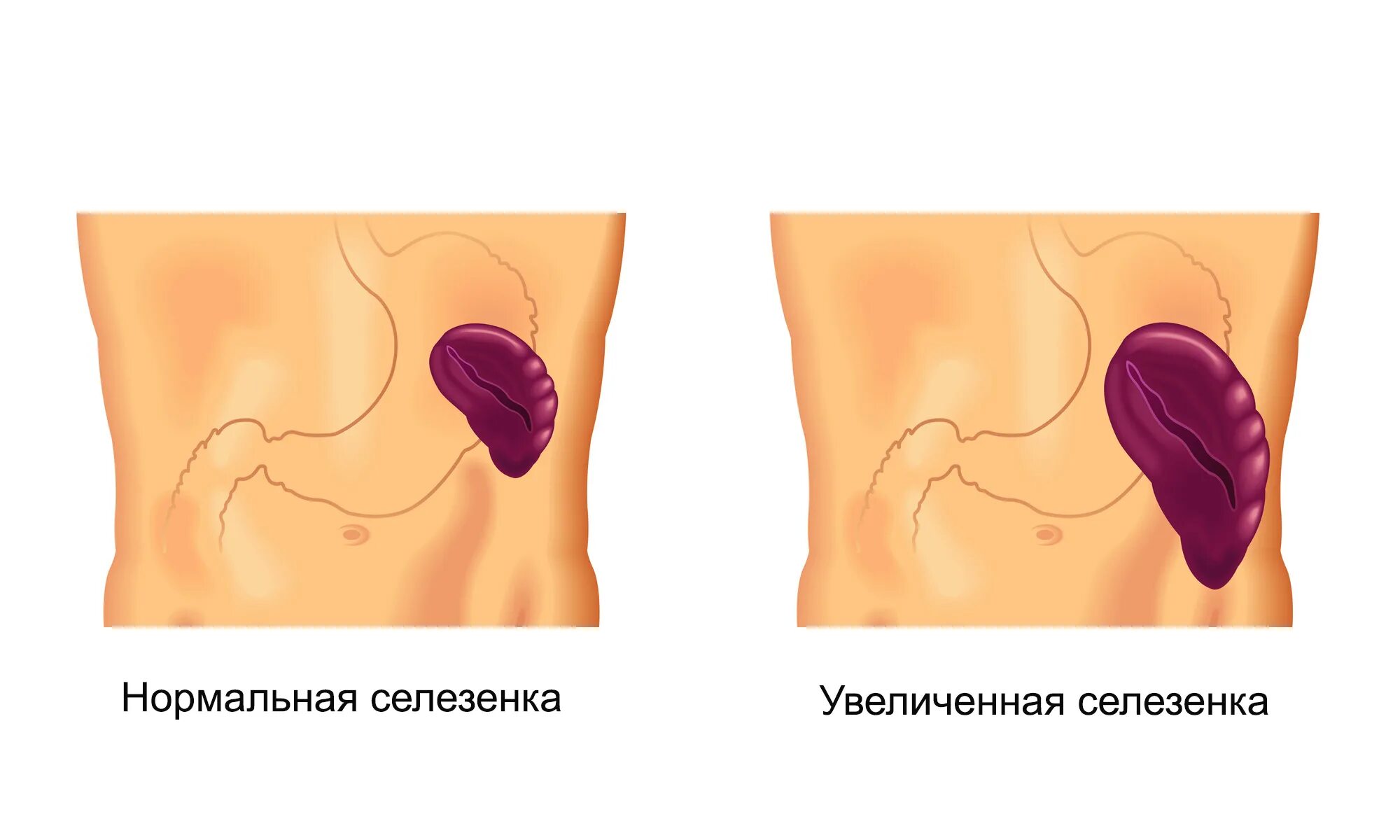 Селезенка может болеть