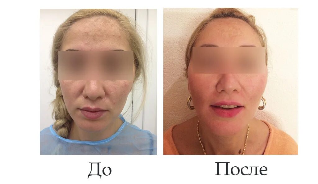 Отек после лифтинга