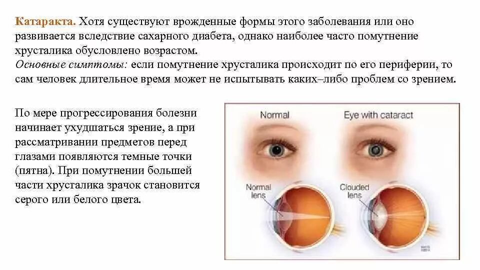 Гигиена зрения предупреждение глазных болезней 8 класс. Катаракта – помутнение хрусталика глаза.. Катаракта презентация.