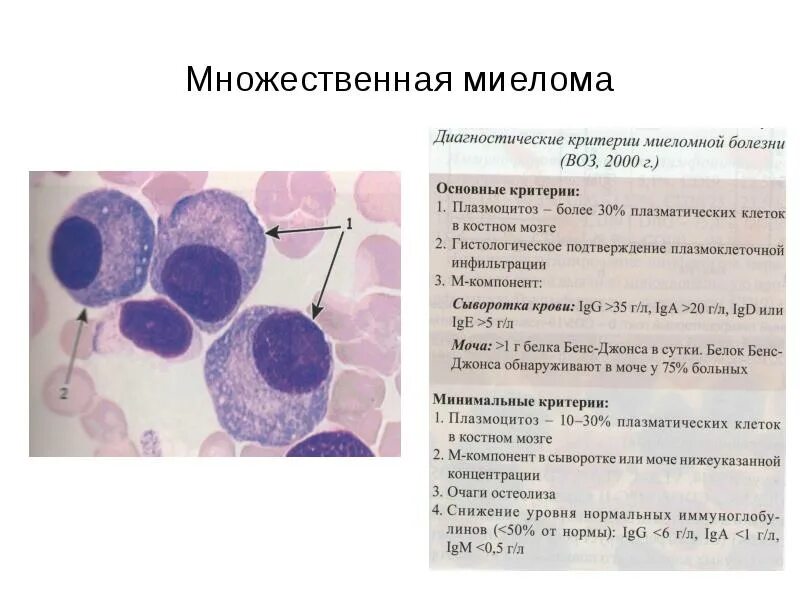 Множественная миелома плазматические клетки. Миеломная болезнь плазматические клетки. Картина крови при множественной миеломе. Картина крови при миеломной болезни. Множественные исследования