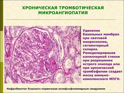 Мр картина проявлений микроангиопатии