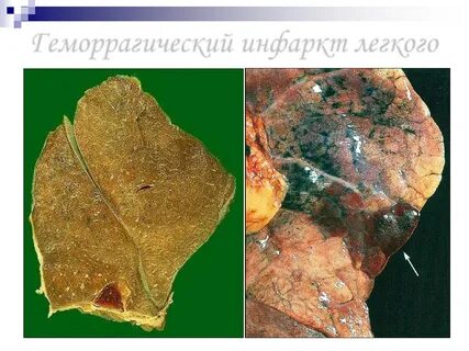 Красный инфаркт
