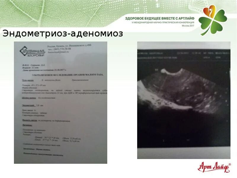 При аденомиозе можно забеременеть. Аденомиоз и эндометриоз. Аденомиоз УЗИ заключение. Эндометриоз УЗИ заключение.