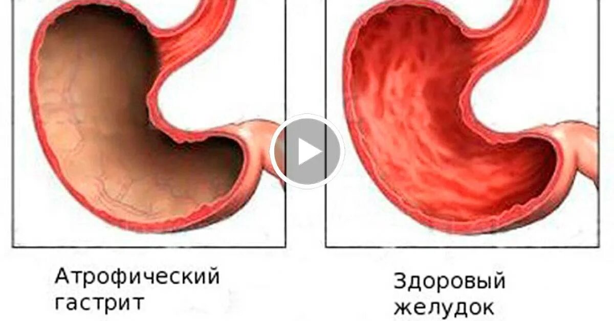 Атрофический гастрит с ахлоргидрией. Симптомы атрофического гастрита желудка. Хронический атрофический гастрит. Атрофия слизистой оболочки желудка. Слизистая атрофична