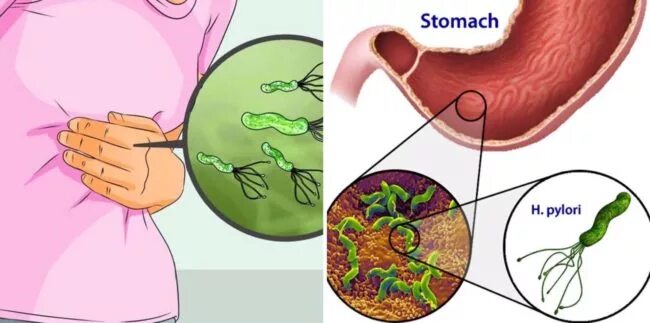Хеликобактер язык. Хеликобактер пилори слизь. Хеликобактер пилори симптомы. Язва желудка бактерия хеликобактер. Гастрит хеликобактер пилори.