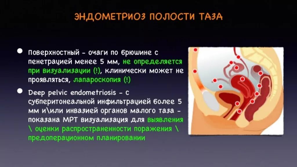 Что такое признаки внутреннего эндометриоза матки