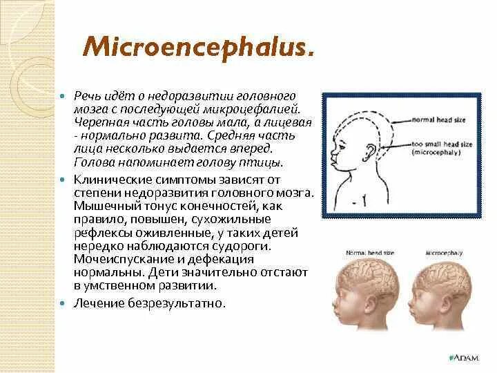 Микроцефалия причины. Микроцефалия окружность головы. Микроцефалия причины возникновения. Микроцефалия и макроцефалия это.