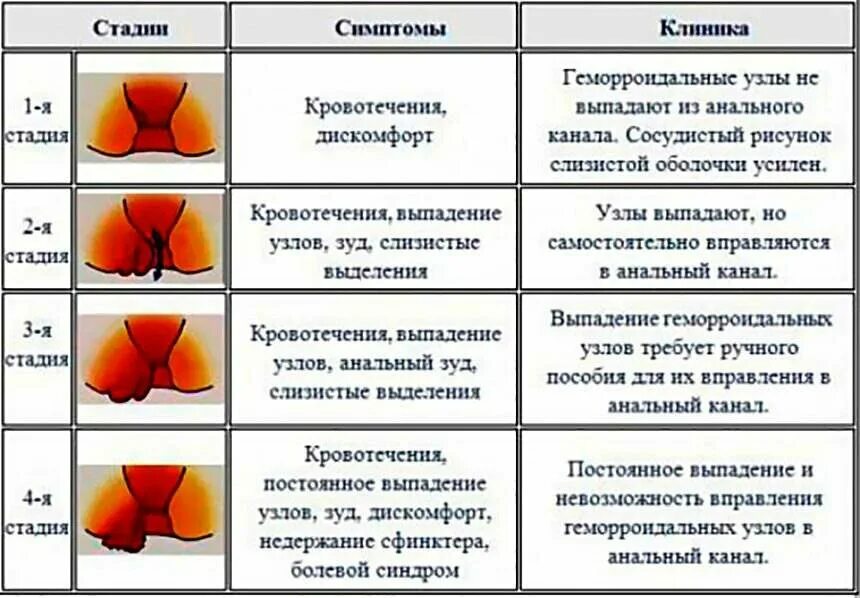 Геморрой наружный узел при беременности. Геморрой начальной стадии наружные узлы. Стадии развития геморроя. Наружный геморрой при беременности 3