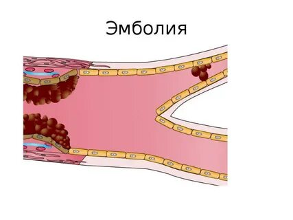 Тромб и эмбол