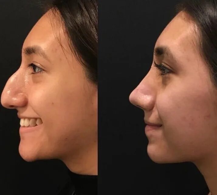 Ринопластика меняет внешность. Изменила под носом. После пластики носа лицо изменилось. Безхирургическая ринопластика. Изменила под носом.