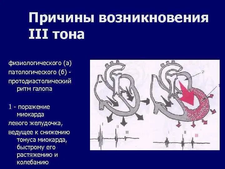 Ритм галопа при каком заболевании. Ритм галопа при каком заболевании
