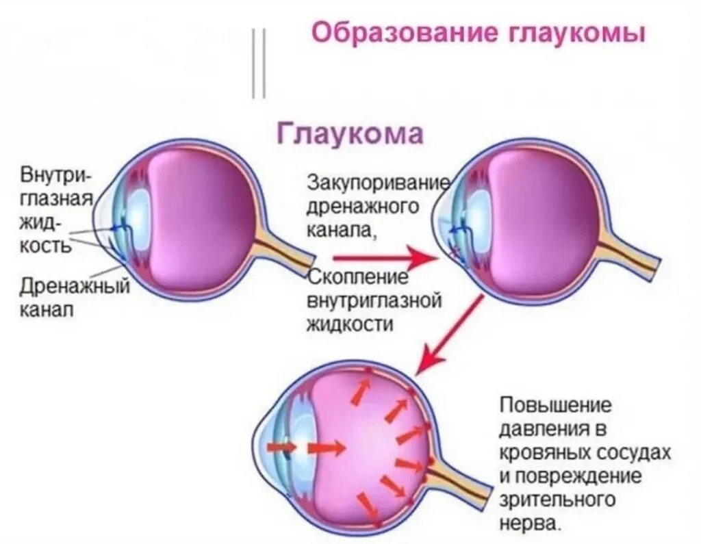 Что делать при глаукоме глаза. Глаукома схема глаза. Глазная глаукома симптомы.