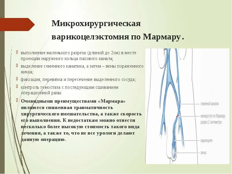 Воспаление семенного канатика у мужчин. Микрохирургическая варикоцелэктомия. Микрохирургическая варикоцелэктомия по Мармару. Операция Мармара (микрохирургическая варикоцелэктомия). Метод Мармара варикоцеле.