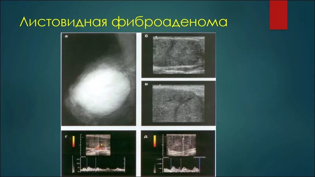 Фиброаденомы форум отзывы. Листовидная фиброаденома молочной. Филлоидная фиброаденома. Листовидная фиброаденома рентген. Листовидная опухоль(филлоидная фиброаденома)молочной железы.