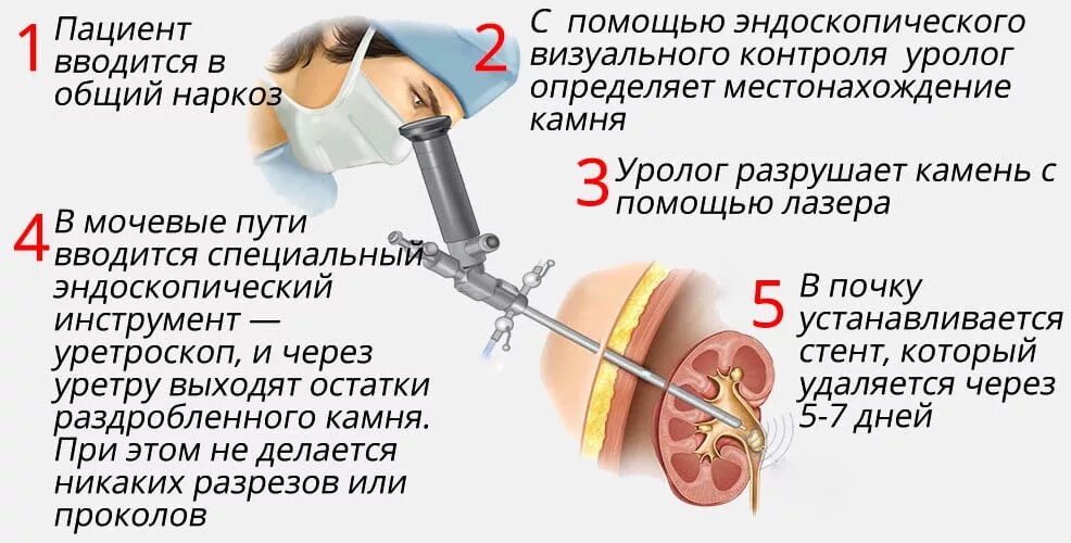 Сколько времени надо после операции. Как удаляются камни из почек. Как удаляют камни из почек. Эндоскопическая контактная литотрипсия. Контактная литотрипсия камней мочеточника.