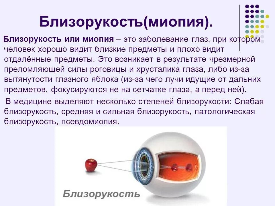 Миопия. Близорукость миопия. Болезнь глаз близорукость. Миопия что это простыми словами