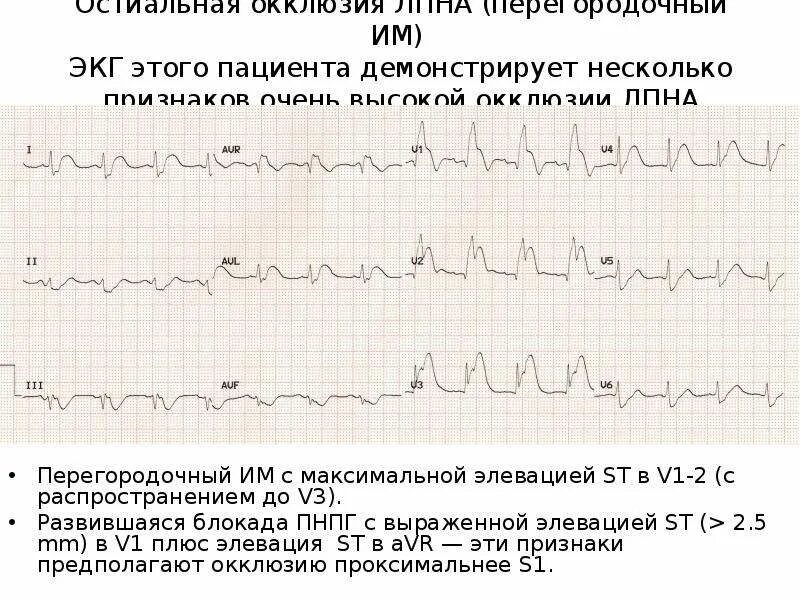 Изменение миокарда передне перегородочной области. Инфаркт ЭКГ элевация St. Элевация St в v1. ЭКГ передне перегородочный инфаркт. Элевация сегмента St на ЭКГ.