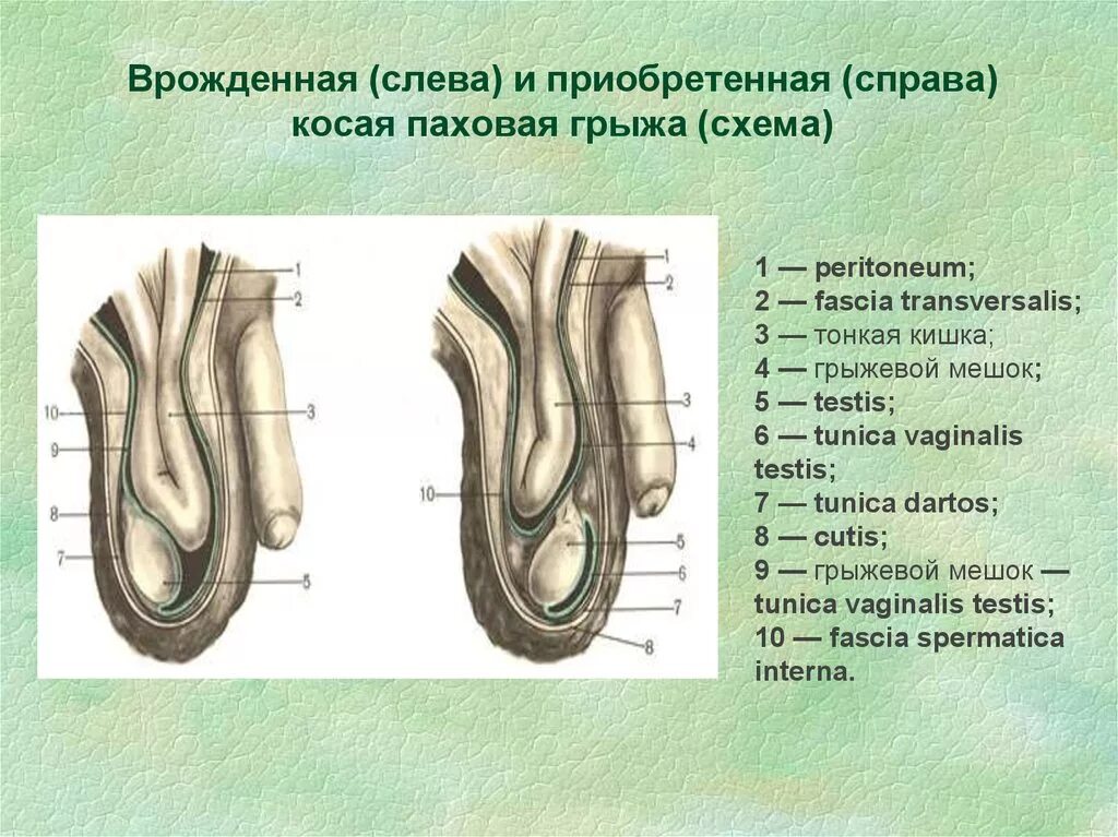 Врожденная косая паховая грыжа. Косая паховая грыжа анатомия. Паховая грыжа схема строения. Косая паховая грыжа хирургическая анатомия. Прямая и косая паховые грыжи