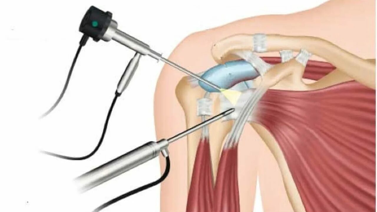 Операция по восстановлению коленного сустава. Операция артроскопия коленного сустава. Артроскоп эндоскопический. Разрыв мениска артроскопия. Артроскопия плечевого сустава Банкарта.