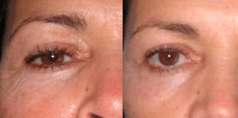 холодная плазма до и после. холодная плазма до и после. плазменное омоложение лица. холодная плазма до и после. аппарат плазма пен блефаропластика.