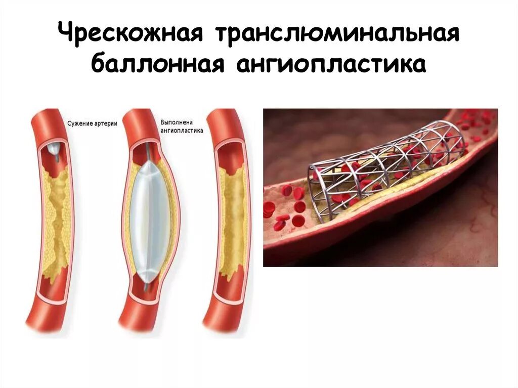 Баллонная коронарная ангиопластика. Чрескожная ТРАНСЛЮМИНАЛЬНАЯ коронарная ангиопластика. Коронарная ангиопластика и стентирование. ТРАНСЛЮМИНАЛЬНАЯ ангиопластика сосудов. ТРАНСЛЮМИНАЛЬНАЯ баллонная ангиопластика коронарных артерий.