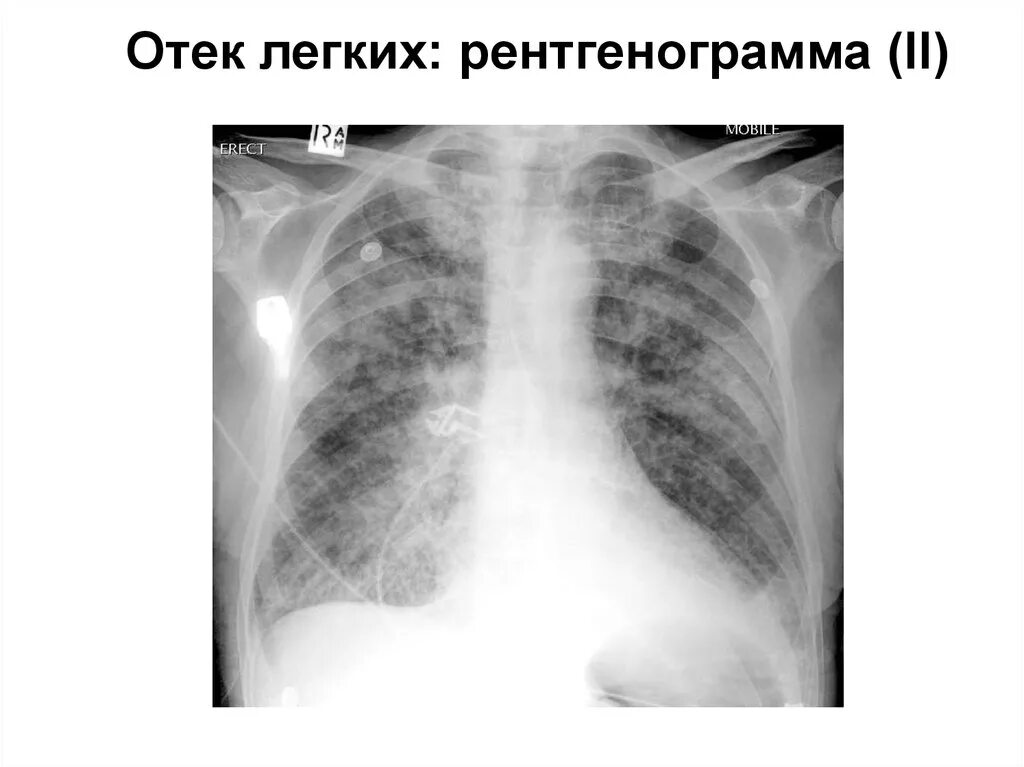 Некардиогенный отек легких рентгенограмма. Уремическая пневмония рентген. Отек легких рентген.