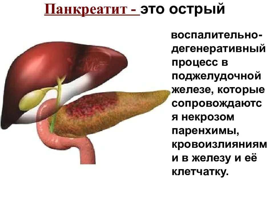 Диффузное увеличение поджелудочной. Острый панкреатит поджелудочной железы. Что такое панкреатит поджелудочной. Болезнь хронический панкреатит поджелудочной железы. Желчекаменная болезнь и панкреатит связь.