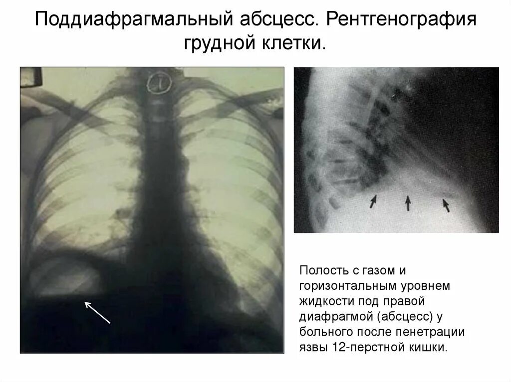 Подпеченочный абсцесс. Поддиафрагмальный абсцесс рентген. Подпеченочный абсцесс рентген. Поддиафрагмальный инфильтрат. Поддиафрагмальный абсцесс на рентгенограмме.