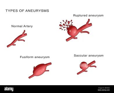 Aneurysm перевод