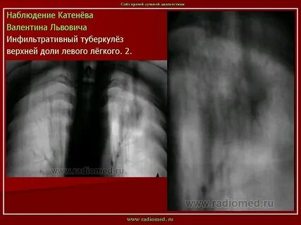 Инфильтрация левой доли легкого
