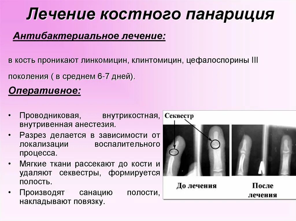 Операция при суставном панариции. Классификация подногтевой панариция. Поверхностный панариций клиника. Классификация панарициев хирургия.