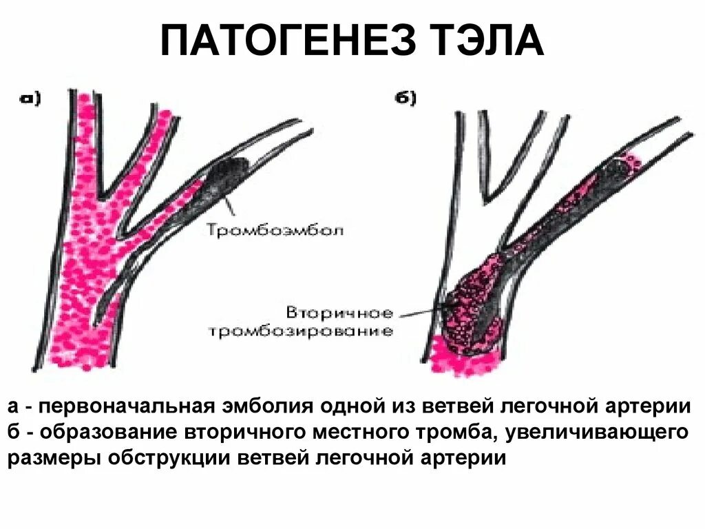 Легочная тромбоэмболия прогноз. Тромбоэмболия ветвей легочной артерии. Тромбоэмболия легочной артерии этиология. Тэла патогенез.