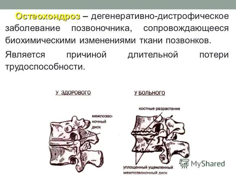 Дегенеративные поражения позвоночника. Дегенеративно-дистрофические заболевания позвоночника. Этиология дегенеративно-дистрофических заболеваний позвоночника. Дегенеративно-дистрофического поражения позвоночника классификация. Дегенеративно-дистрофические изменения позвонков.