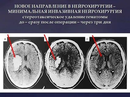 Геморрагический инсульт сколько живут