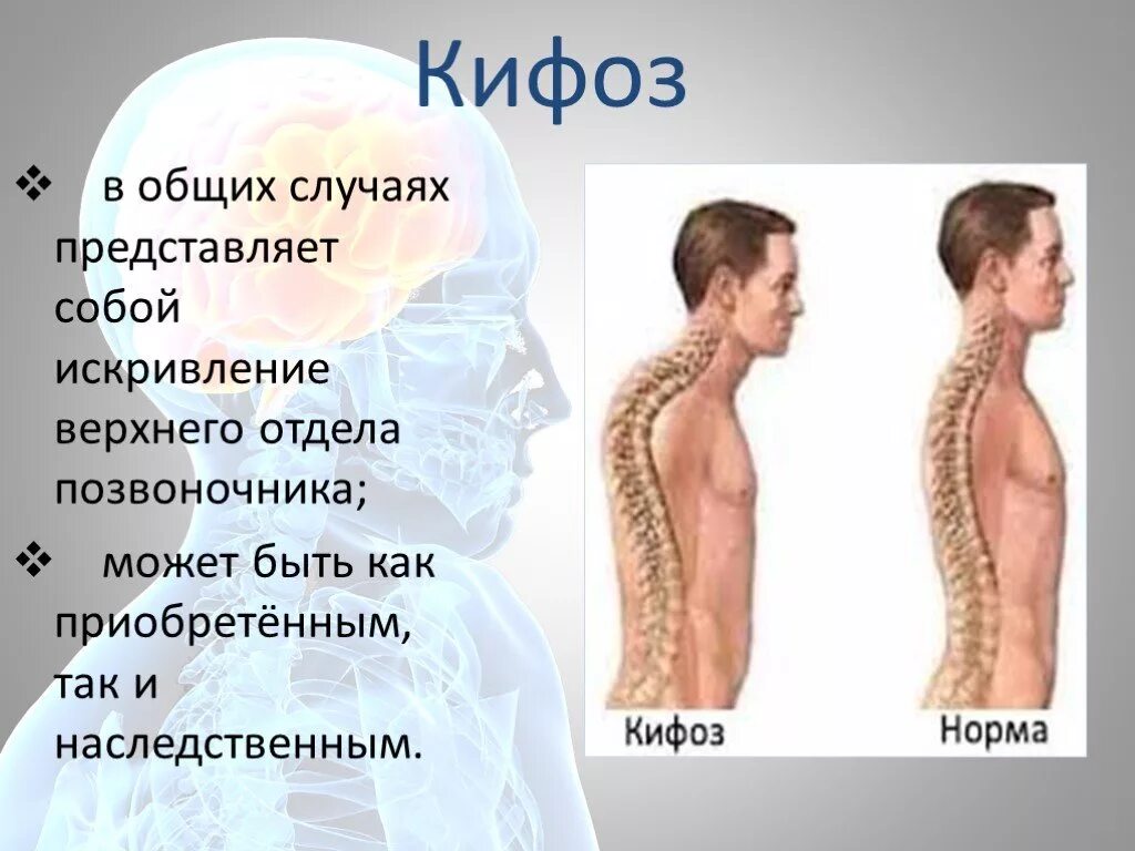 Кифоз шейно грудного отдела позвоночника. ФО ки. Кифоз позвоночника.