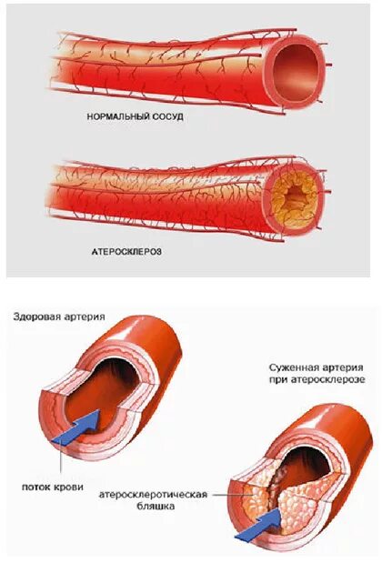 Атеросклеротическое поражение кровеносных сосудов. Сосуды поражаются атеросклерозом. Причины атеросклероза коронарных сосудов. Расположение атеросклеротических бляшек. Расширение сужение кровеносных сосудов кожи