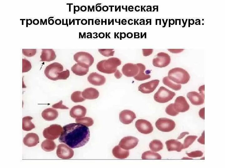 Тромбопения это. Идиопатическая тромбоцитопеническая пурпура сыпь. Картина крови при тромбоцитарной пурпуре. Идиопатическая (иммунная) тромбоцитопеническая пурпура. Геморрагическая сыпь геморрагическая тромбоцитопения.
