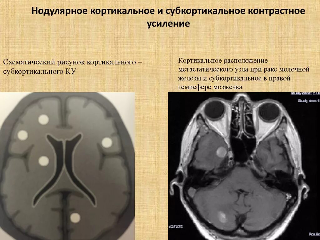 Лиссэнцефалия-пахигирия. Субкортикальное вещество что это. Кортикальные и субкортикальные отделы головного мозга кт. Субкортикальная лейкомаляция. Субкортикальная гетеротопия серого вещества.