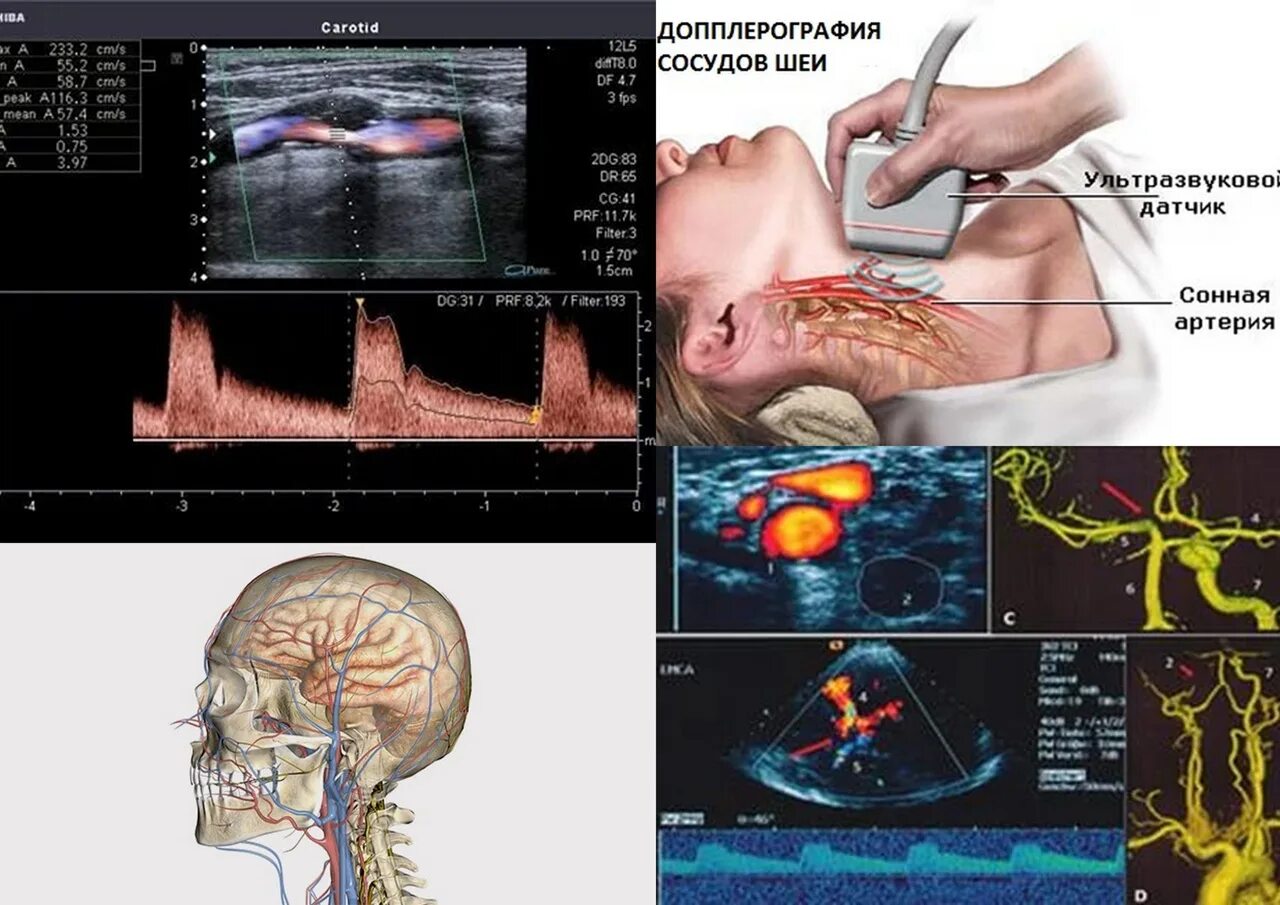 Узи артерий мозга. Ультразвуковая допплерография сосудов головы. УЗДГ сосудов головы и шеи. Транскраниальная ультразвуковая допплерография. Допплерография сосудов головы и шеи.
